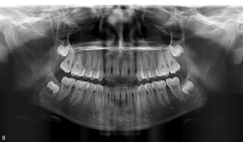 Radiographie panoramique adulte